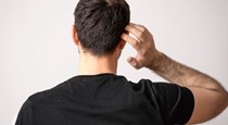 No to dandruff: Scalp care tips every man needs to know