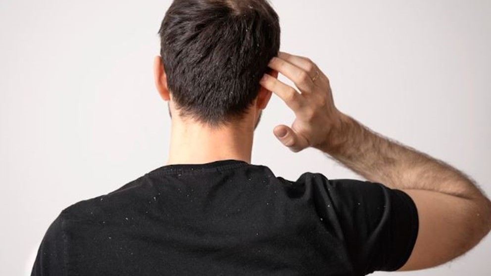 No to dandruff: Scalp care tips every man needs to know
