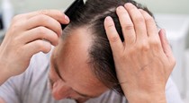 Superfoods to eat to reduce hair loss