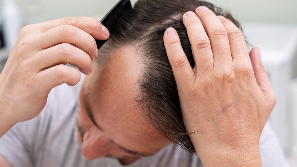 Superfoods to eat to reduce hair loss