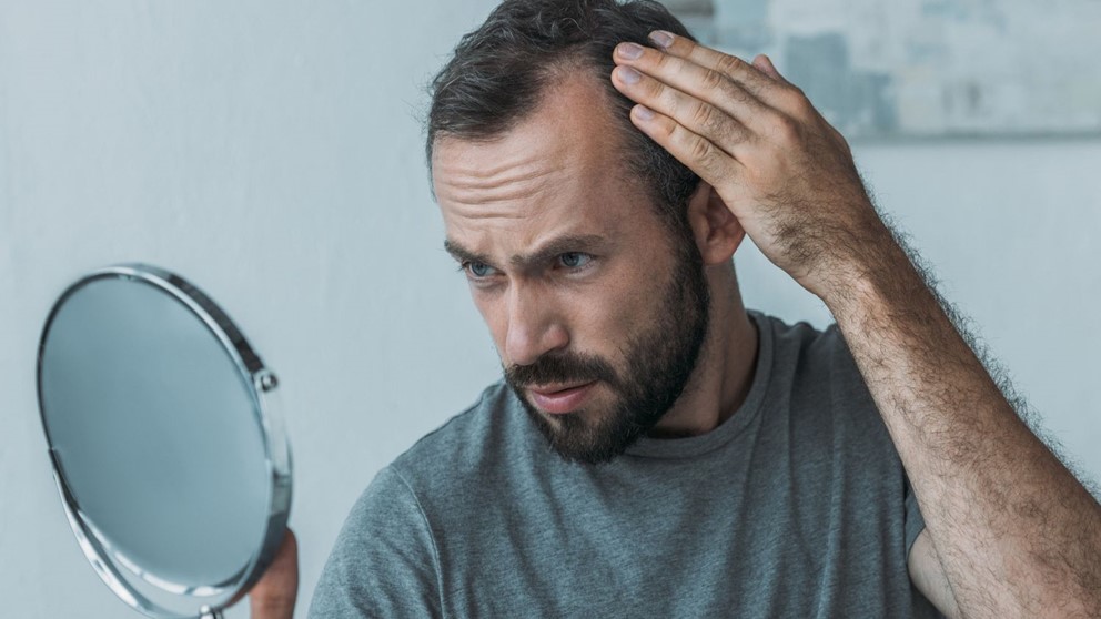 Exploring hair loss in men over the age of 35
