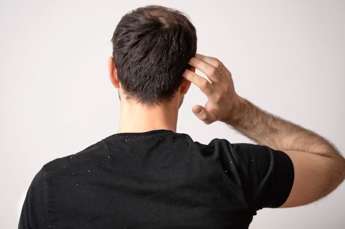 No to dandruff: Scalp care tips every man needs to know