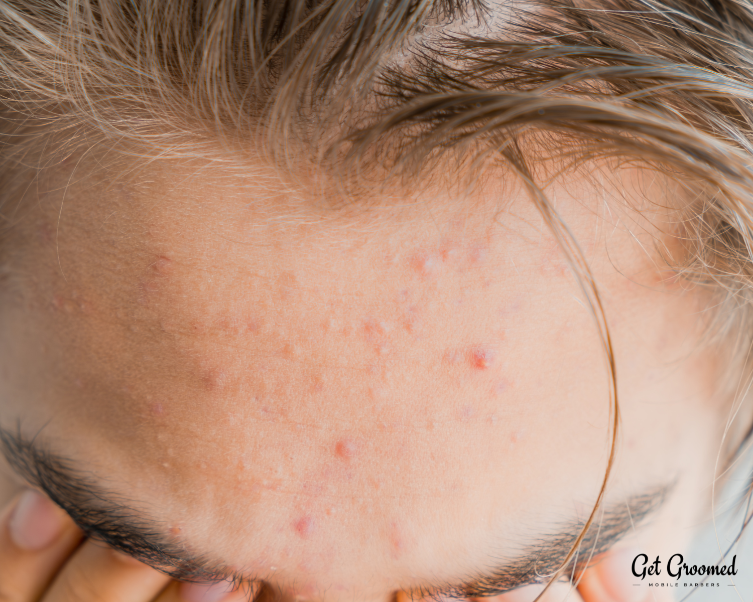How to Prevent Hairline Acne from Hair Products Men Commonly Use
